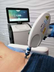 laserowe usuwanie blizn.jpg